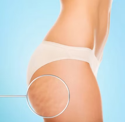 Élimitation cellulite