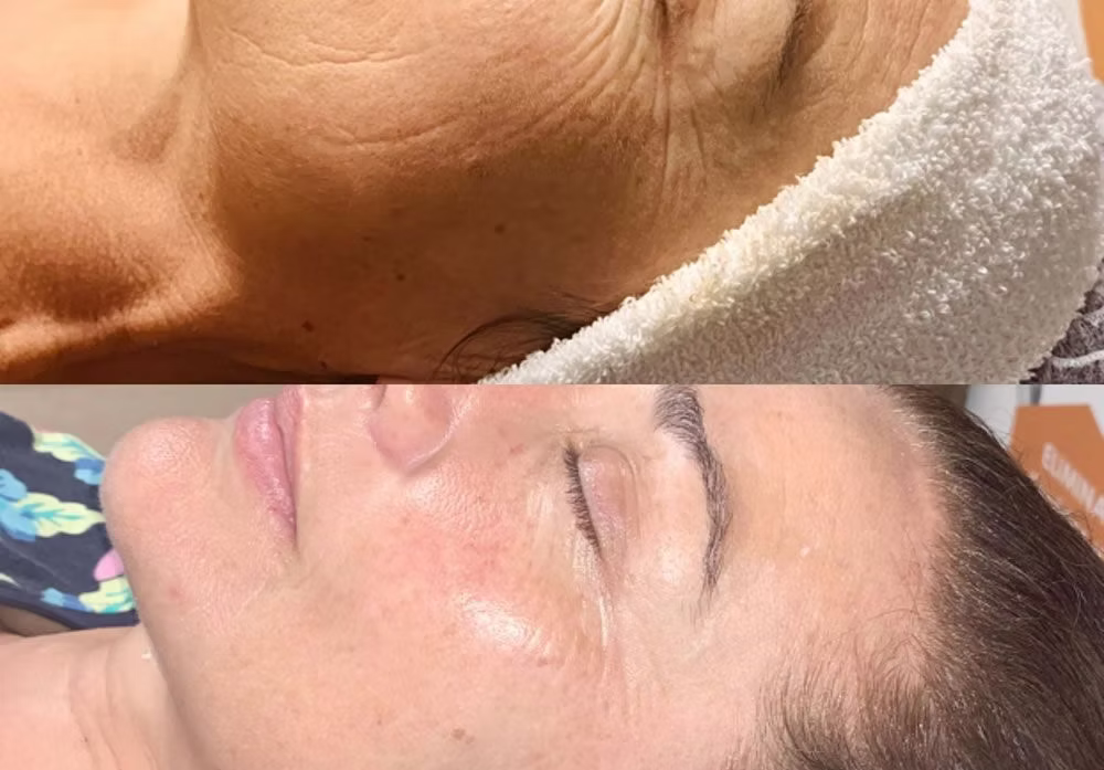 6 séances - rides visage