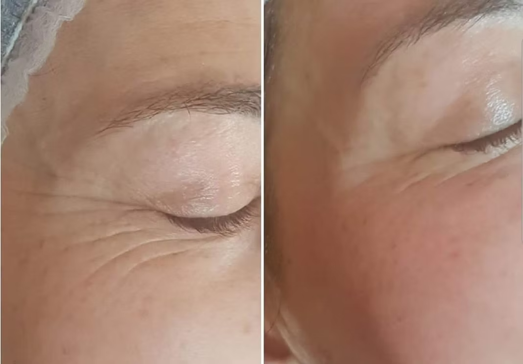 1 séance - rides yeux